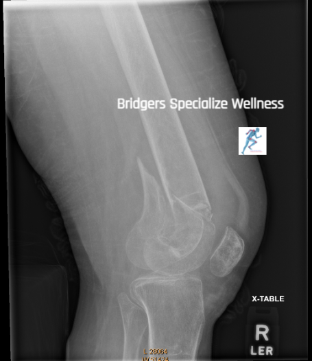 Before : Reflex Pts Correction Therapy October 4th