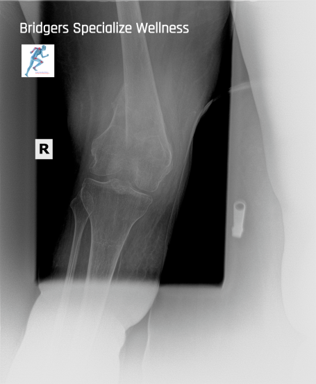 After: front view bone repaired